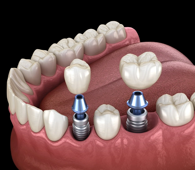 same day dental implants frisco tx 