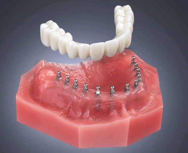 mini dental implants frisco tx