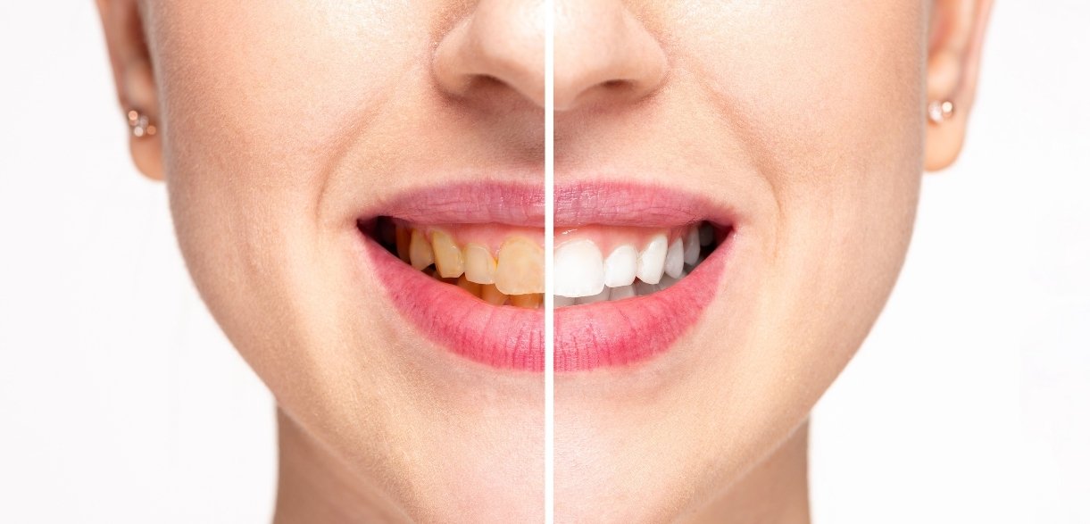 smile confidently this christmas with quick and effective teeth whitening