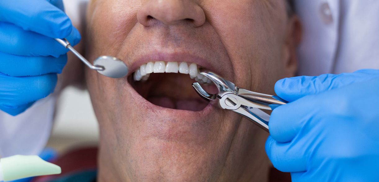 Close-up of a dental extraction procedure being performed on a patient by a dentist in Frisco, TX at V smile dental